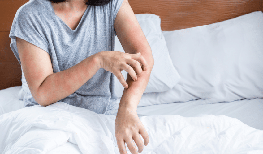 A person scratching at their skin which is red from an allergic reaction